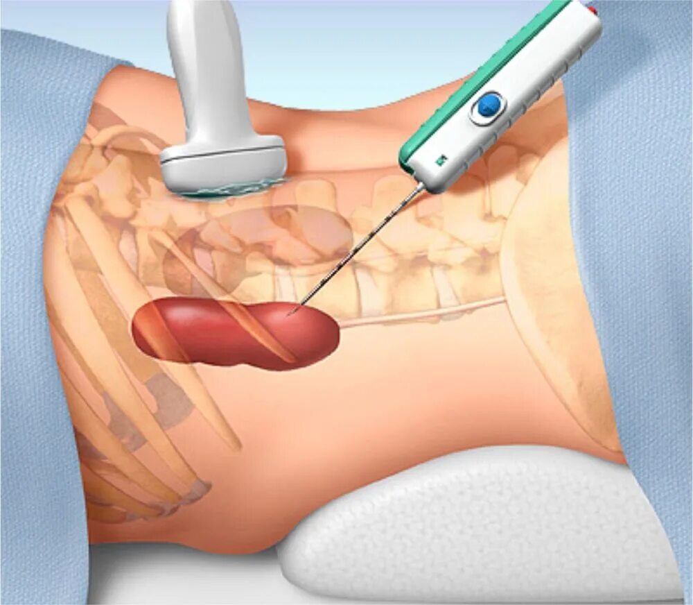Операция по удалению печени. Пункционная биопсия почек. Пункционная биопсия под контролем УЗИ. Чрескожная пункция почки. Диагностическая пункционная биопсия почки.