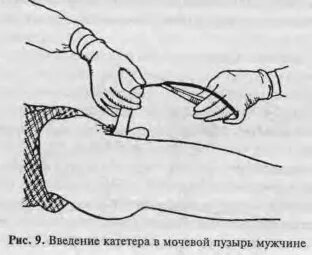 Как установить мочевой катетер. Как установить мочевой катетер