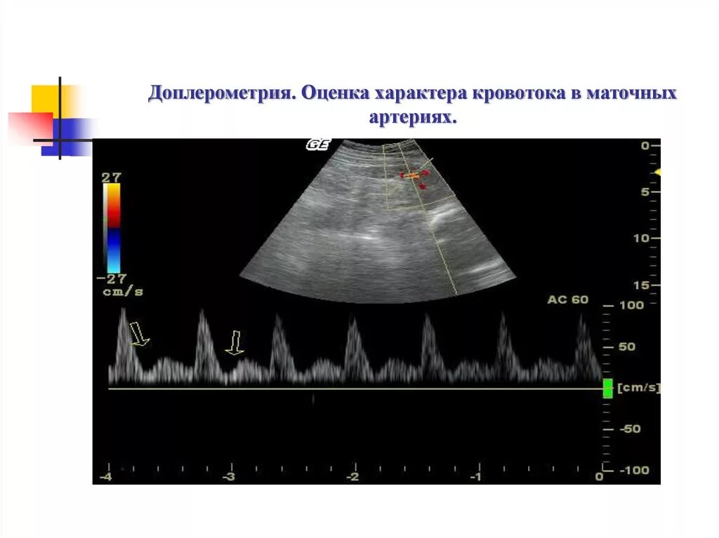 Допплерометрия плодового кровотока. Оценка характера кровотока. Кровоток в маточных артериях. Импульсная спектральная допплерография. Маточная гемодинамика