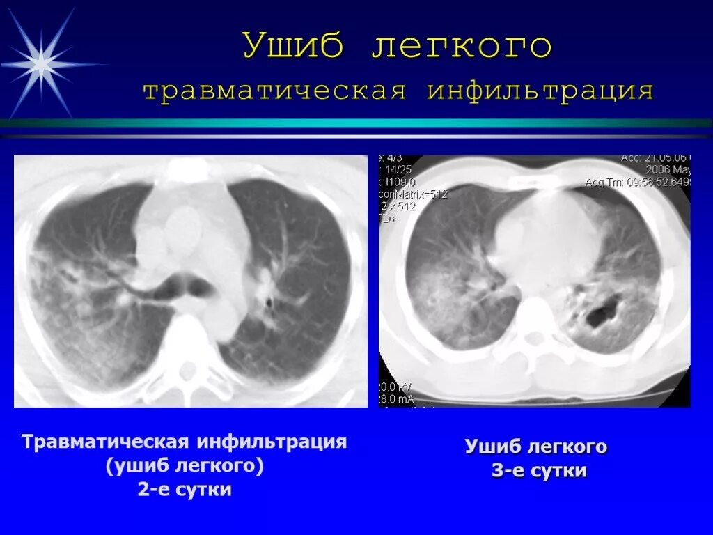 Травматические повреждения легких кт.