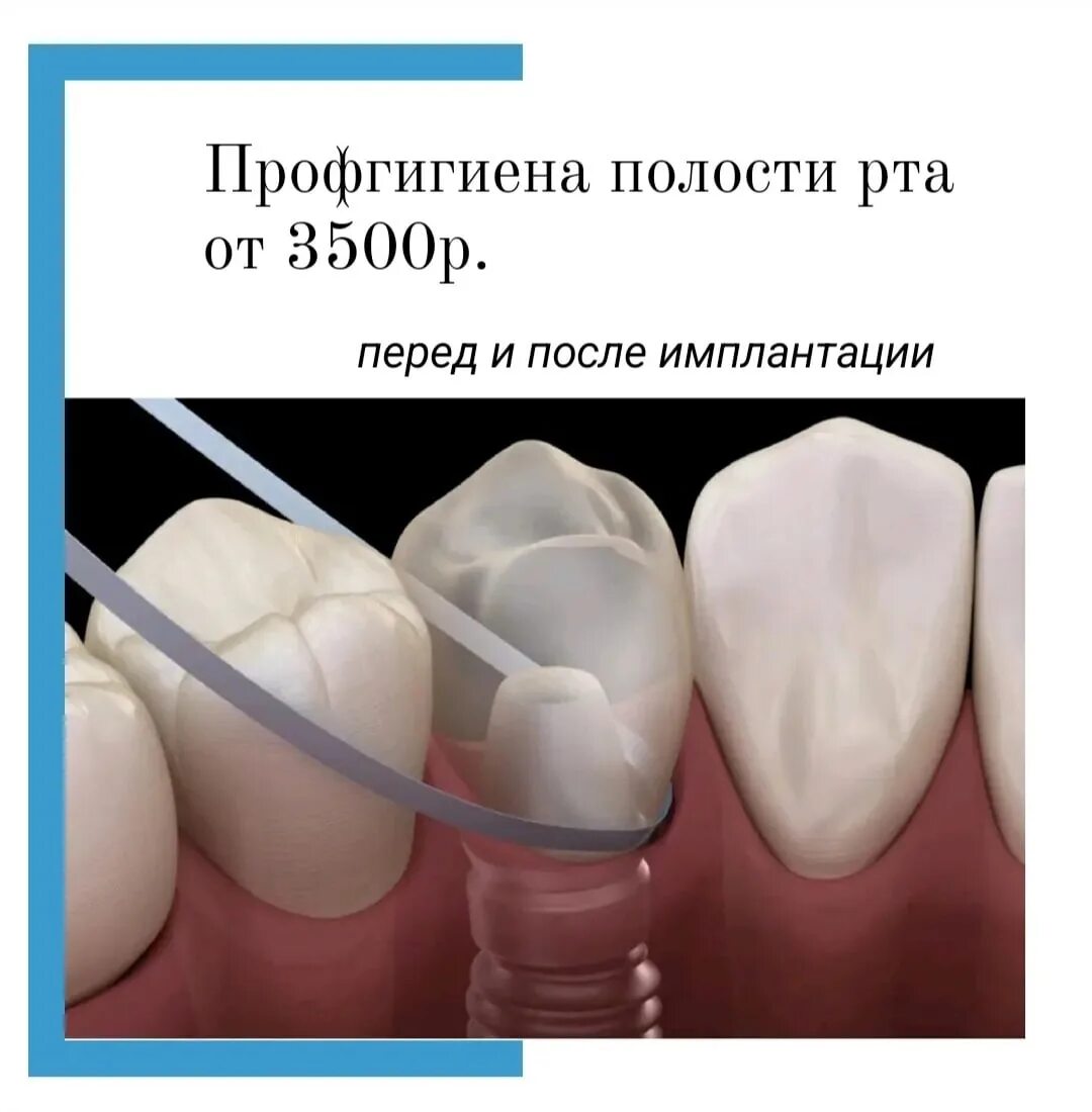 Как чистить зубы после имплантации