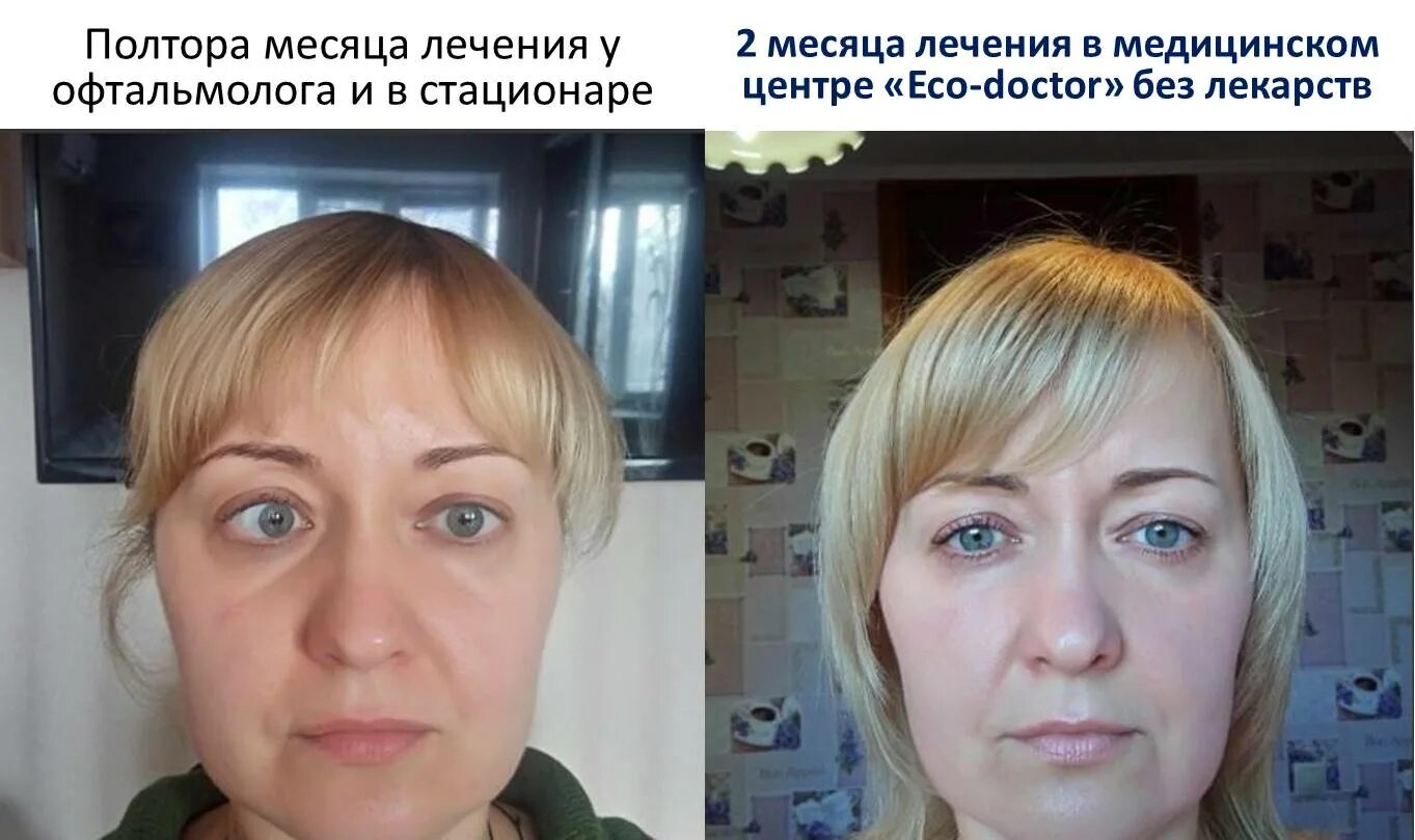 Как исправить косоглазие у взрослых. Операция по косоглазию. операция по косоглазию у взрослых. исправление косоглазия операция. косоглазие коррекция до и после.