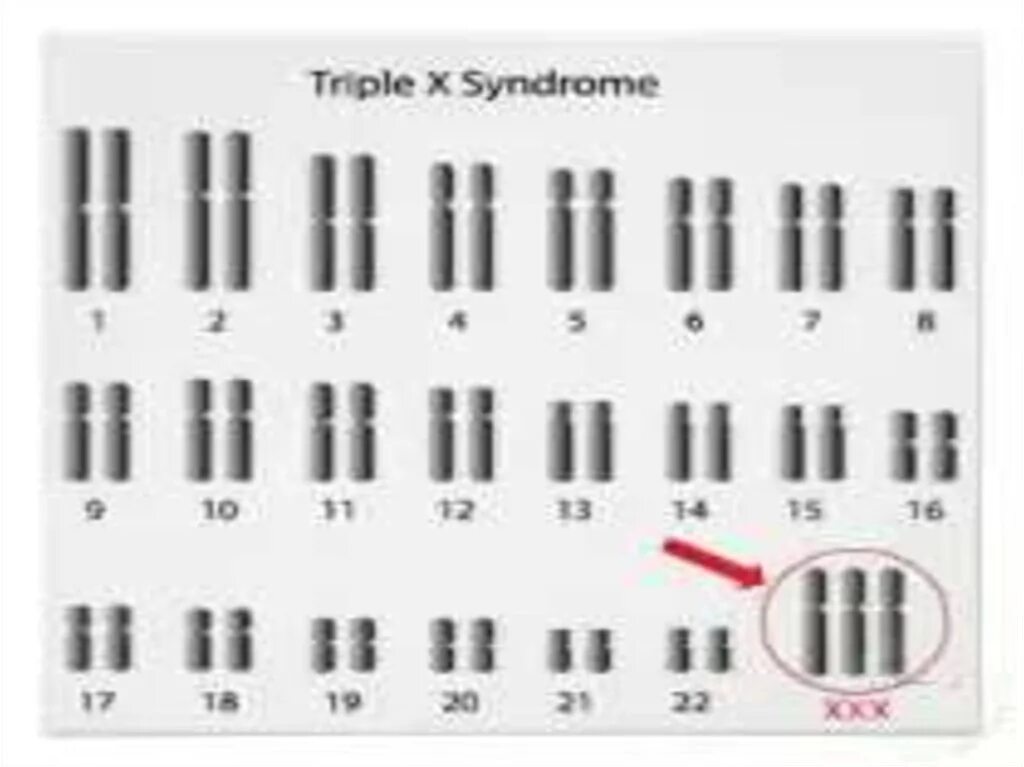 Синдром Клайнфельтера хромосомный набор. Синдром Клайнфельтера кариотип синдром. Синдром Клайнфельтера кариотип. При синдроме Клайнфелтера кариотип больного:. Фото трипло