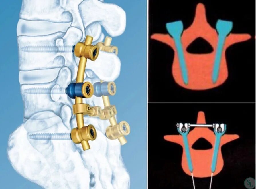 Транспедикулярная система фиксации позвоночника. Транспедикулярная стабилизация позвоночника. Транспедикулярная система фиксации шейного отдела позвоночника. Операция транспедикулярная фиксация позвоночника. Операции на поясничном отделе позвоночника с металлоконструкцией