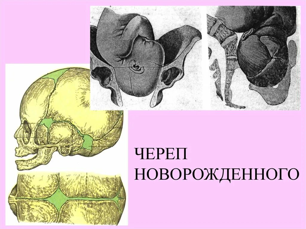 Черепная аномалия. Аномалии развития костей черепа. Череп младенца анатомия. Аномалии черепа новорожденного. Череп новорожденного пороки.