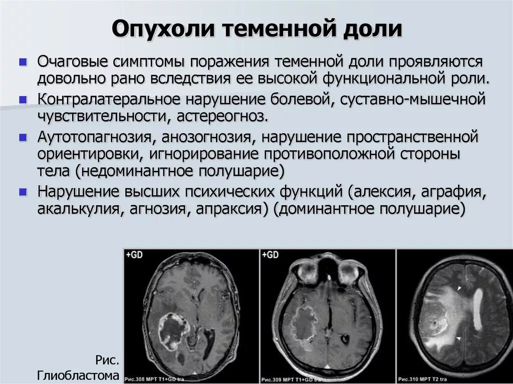 Глиома степени. Глиобластома мультиформная степень 4. Неоперабельная глиобластома головного мозга.. Опухоль головного мозга глиобластома 4. Глиобластома лобной доли мрт.