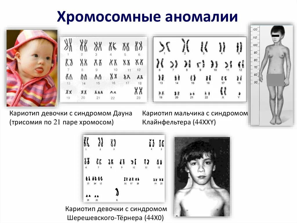 Кариотип человека с синдромом Шерешевского-Тернера. Синдром Дауна трисомия кариотип. Синдром Дауна (трисомия по 21 паре хромосом). Кариотип 46.