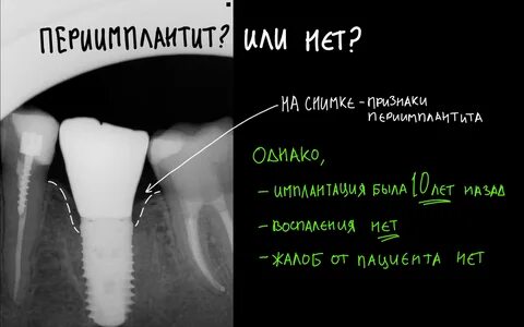 Воспались импланты