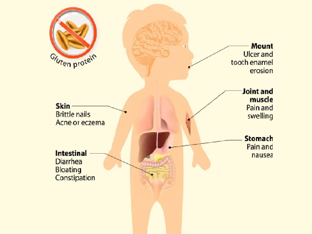 Глютеновая непереносимость симптомы. Симптомы целиакии у детей 4 года. Глютеновая непереносимость симптомы у ребенка 2 года. Первый симптомы ковид