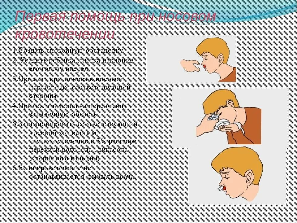 При носовом кровотечении необходимо выполнить. Действия неотложной помощи при носовом кровотечении. Меры оказания первой медицинской помощи при носовом кровотечении. Алгоритм действий при кровотечении при носовом кровотечении. ПМП при носовом кровотечении.