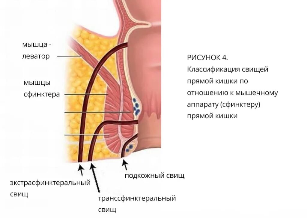 Экстрасфинктерные свищи прямой кишки. Транссфинктерные свищи прямой кишки. Передний транссфинктерный свищ.