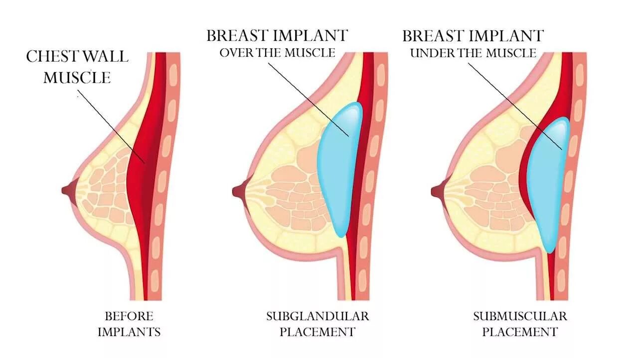 Импланты грудных желез. Операция по подтяжке груди. Увеличение грудных желез. Подтяжка грудных желез с имплантами. Асимметричная грудь.