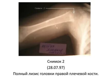 Лизис костей