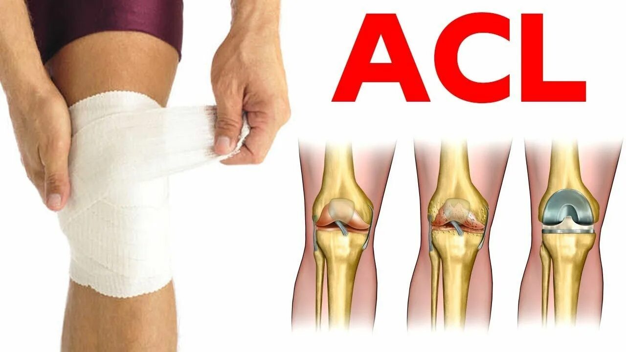 Acl что это. ACL Reconstr. ACL Ace.