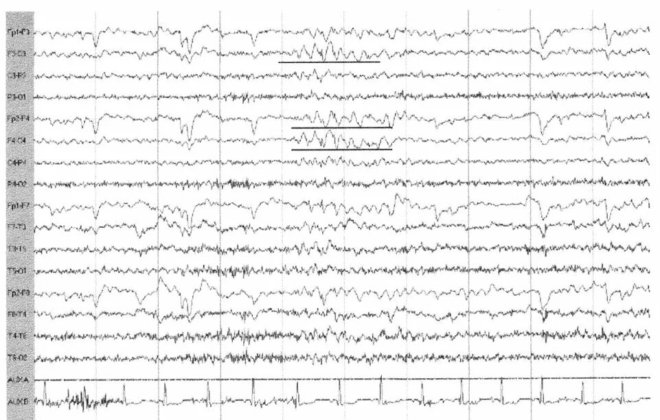 Изменения биоэлектрической активности мозга. Вертекс потенциалы на ЭЭГ. ЭЭГ головного мозга пароксизмальная активность. Пароксизмальная активность на ЭЭГ У взрослого. ЭЭГ при пароксизмальный состояниях.
