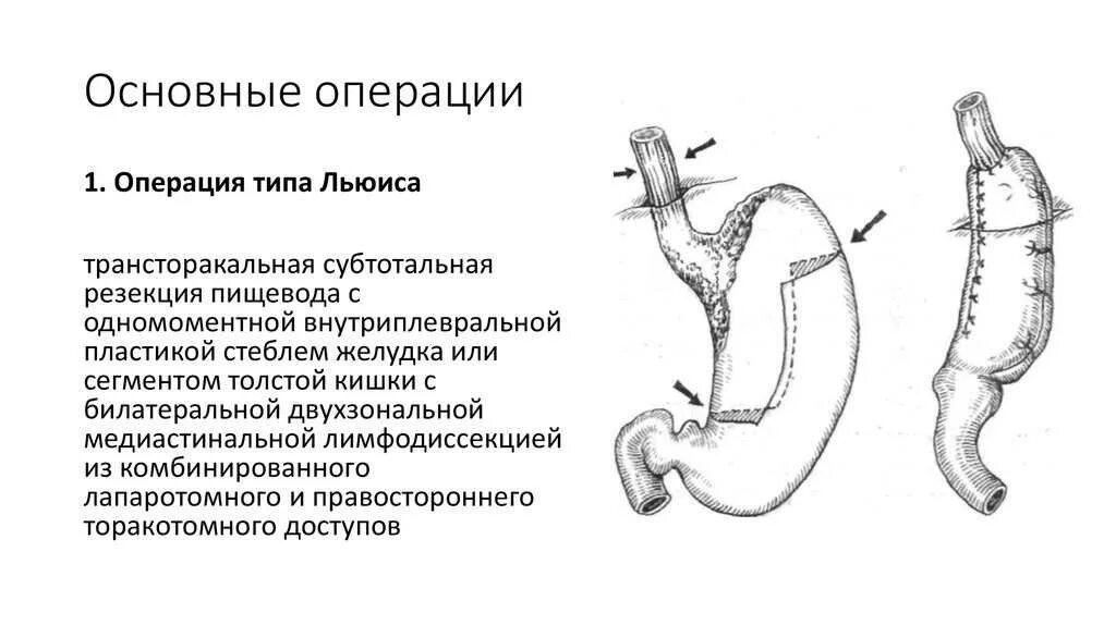 Операции на пищеводе. Проксимальная субтотальная резекция желудка схема. Операция Льюиса пищевод. Операция Льюиса пищевод схема.