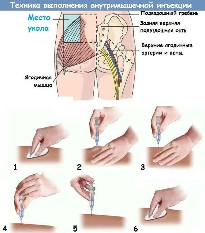 Схема введения внутримышечной инъекции. Как самой себе сделать укол внутримышечно в бедро. Правильно поставить укол внутримышечно. Как правильно ввести внутримышечную инъекцию.