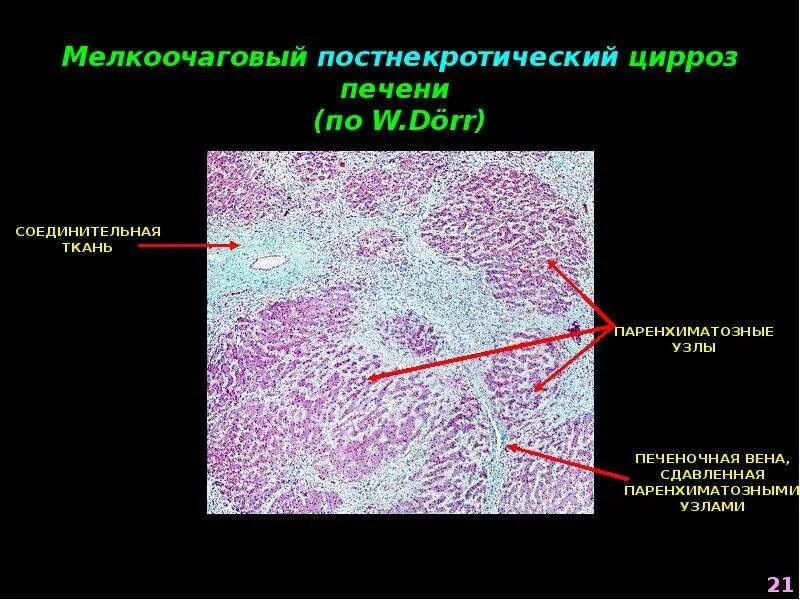 Печень микропрепарат описание. Первичный билиарный цирроз печени патологическая анатомия. Печень цирроз препараты патологическая анатомия. Патологическая анатомия при циррозе печени. Портальный цирроз печени патологическая анатомия.