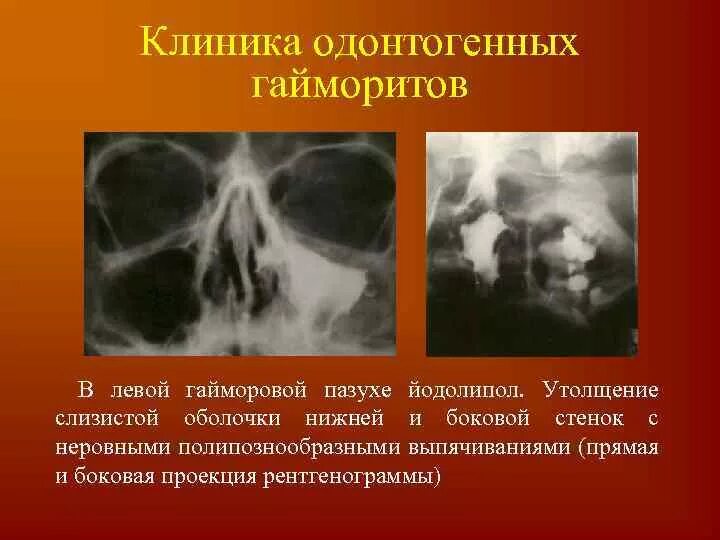 Гайморовых пазух слизистой оболочки. Пристеночный гиперпластический верхнечелюстной синусит. Утолщение слизистой оболочки верхнечелюстных пазух кт. Пристеночное утолщение слизистой верхнечелюстной пазухи. Пристеночное утолщение слизистой верхнечелюстной пазухи рентген.