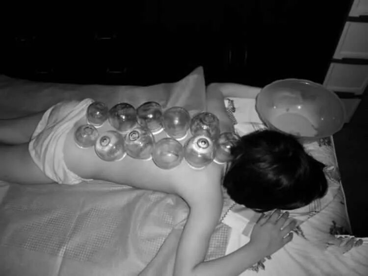 установка банок ребенку. лечебный массаж банками. банки ребенку. банка для детей. детское питание в баночках.