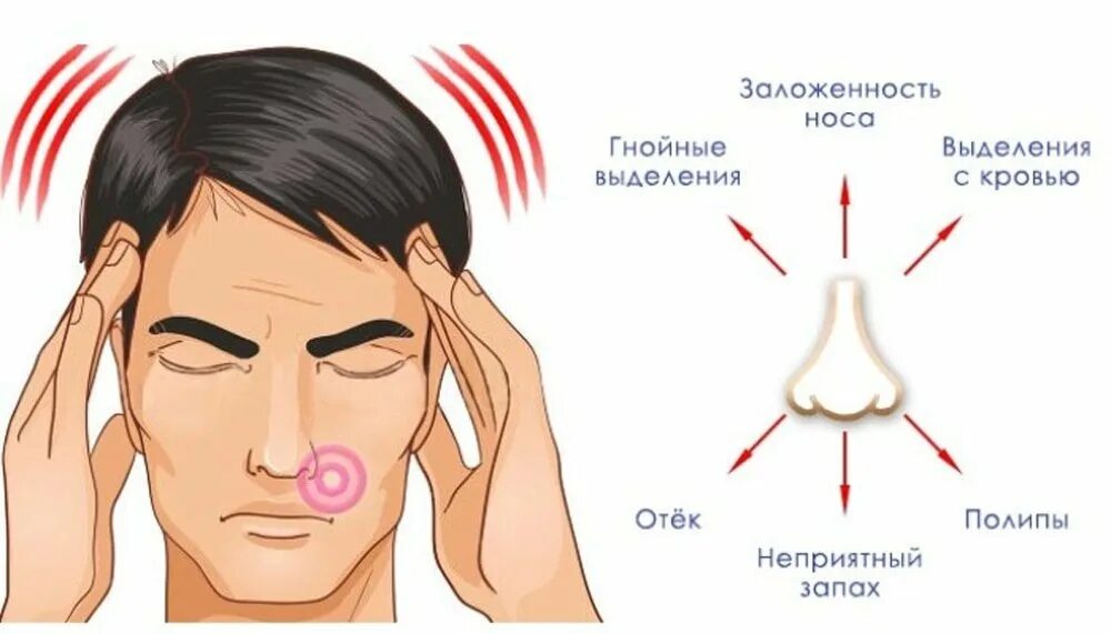 Заложен нос ухо болит голова. Острый синусит симптомы. Симптомы при синусите гайморите.