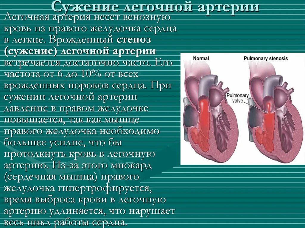 Легочная артерия. Стеноз легочной артерии. Сужение ствола легочной артерии. Передний ствол легочной артерии. Сколько легочных артерий