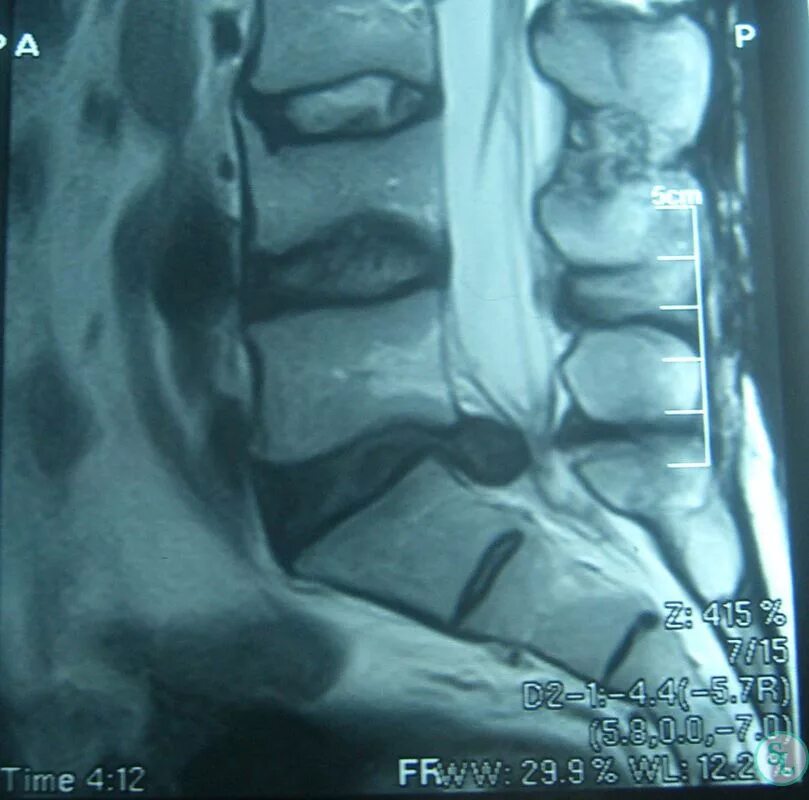 L4 l5 отдел позвоночника протрузия. Межпозвонковый диск l5-s1. Диски l5-s1 в позвоночнике. Экструзия диска l5-s1 что это такое. Межпозвоночная грыжа l4-l5 мрт.
