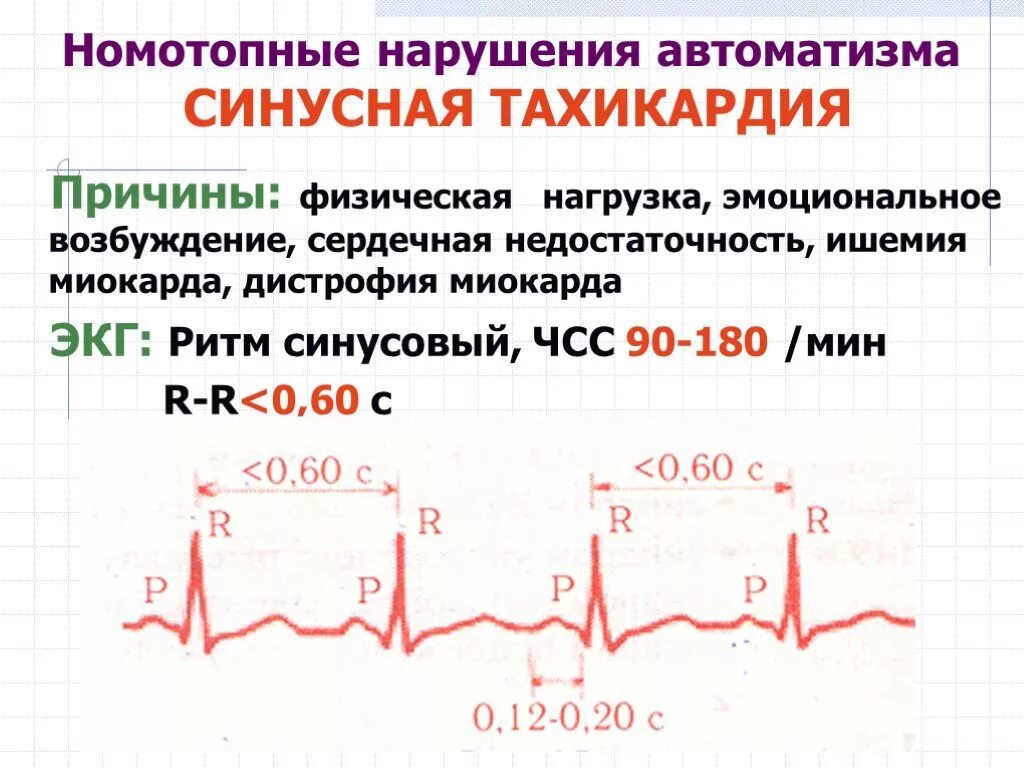 Учащенное сердцебиение при нагрузках. Нарушение функции АВТОМАТИЗМА сердца на ЭКГ. Синусовая тахикардия ЭКГ признаки. ЭКГ брадикардия синусовый ритм. Синдром тахикардии-брадикардии на ЭКГ.