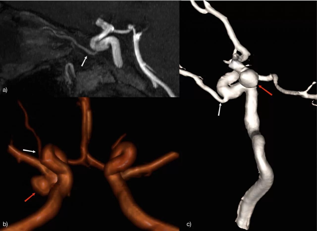 Гипоплазия интракраниальных сегментов позвоночных артерий. Гипоплазия интракраниальных сегментов позвоночных артерий. Гипоплазия р1 сегмента мозговой артерии. Аневризма позвоночной артерии. Сегменты v1 v2 позвоночных артерий.