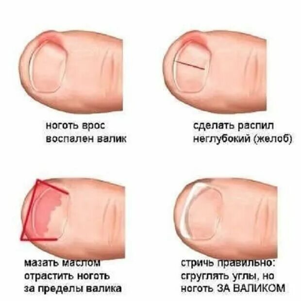 Как выглядит вросший ноготь у кошки Gloves. Step