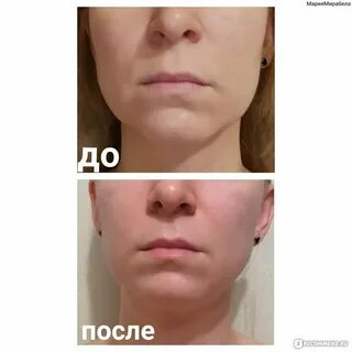 Отеки после кс