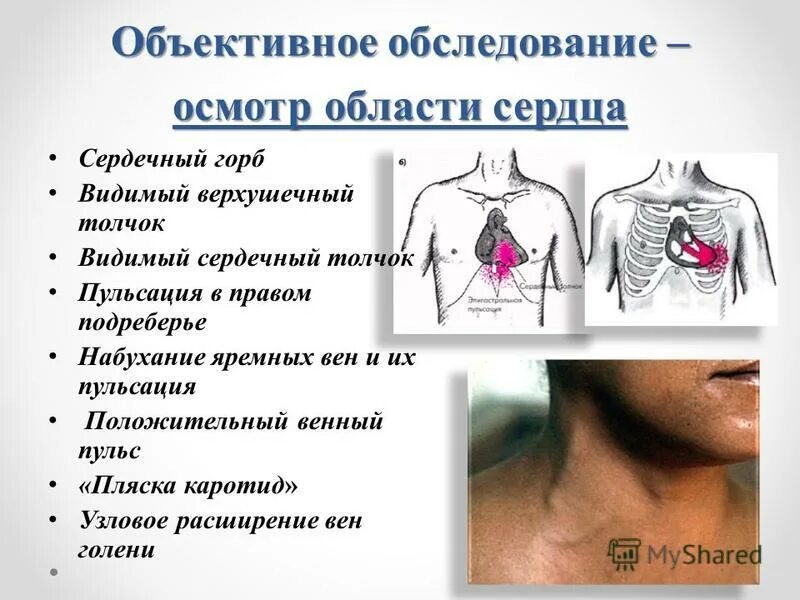 сердечный горб грудная клетка. деформация грудной клетки сердечный горб. сердечный горд. сердечный горд. сердечный горд.