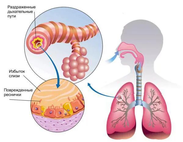 Хронический трахеобронхит. Обструктивный бронхит у курильщиков. Трахеобронхит лечение кашля