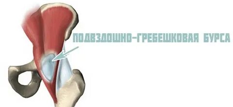 Седалищный бурсит тазобедренного сустава лечение