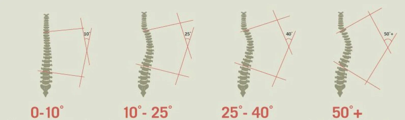Степени сколиоза по Кобба. Степени сколиоза позвоночника по коббу. Угол Кобба степени сколиоза. Сколиоз 2 степени угол искривления 17. Угол кобба