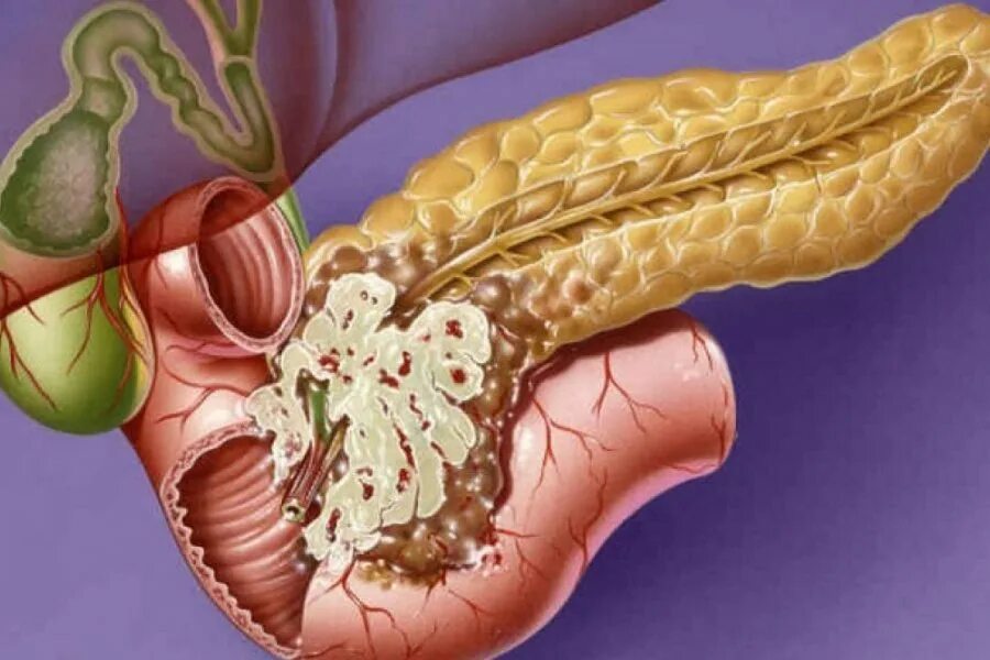 4 стадия поджелудочной железы сколько живут. Липофиброматоз поджелудочной. Липоматоз поджелудочной железы. Аденокарцинома поджелудочной железы. Липоматоз поджелудочной железы макро.
