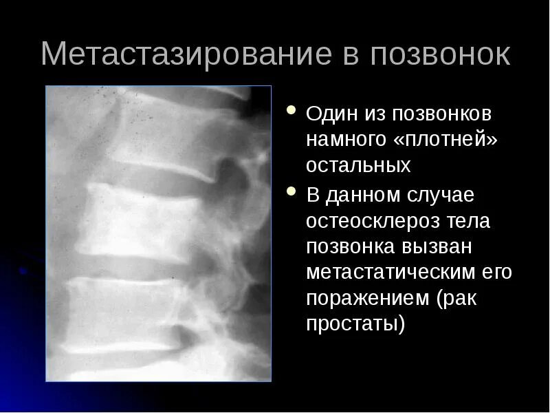 Остеосклероз грудного отдела