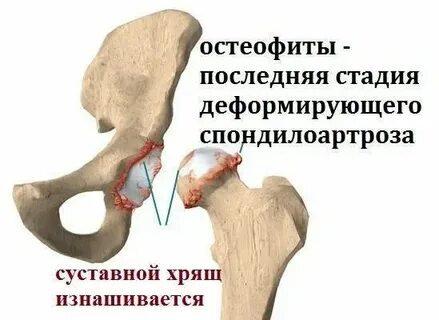 Остеофит народные средства