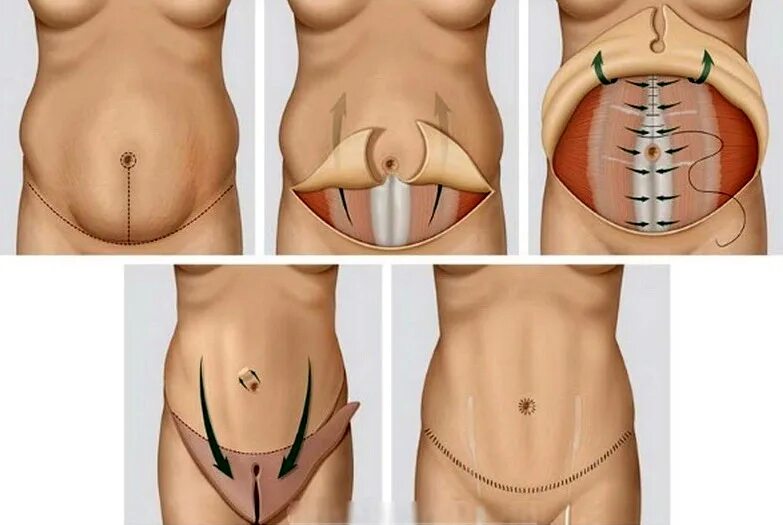 Абдоминопластика после кесарева. Операция абдоминопластика живота после операции. Липоабдоминопластика схема.
