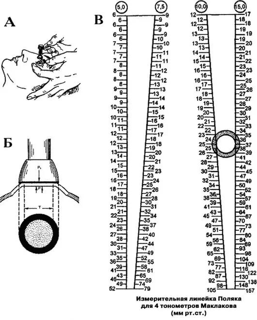 Внутриглазное давление по маклакову. Измерение внутриглазного давления тонометром Маклакова. Измерение глазного давления по маклакову алгоритм. Тонометрия по маклакову (измерение внутриглазного давления). Нормы внутриглазного давления при измерении тонометром Маклакова:.