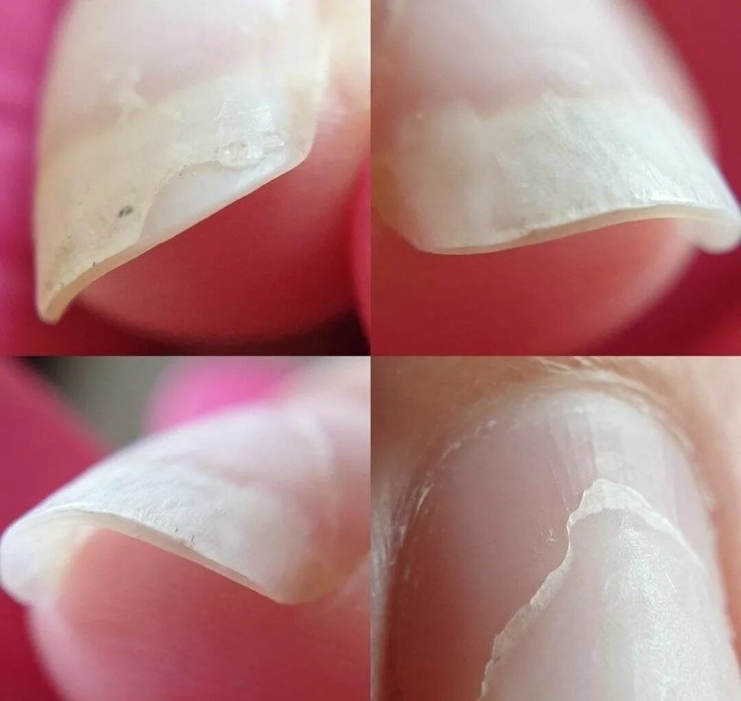Почему гель быстро отслаивается от ногтя. Отлоение ногти от гель лак. Отслойка материала на ногтях.