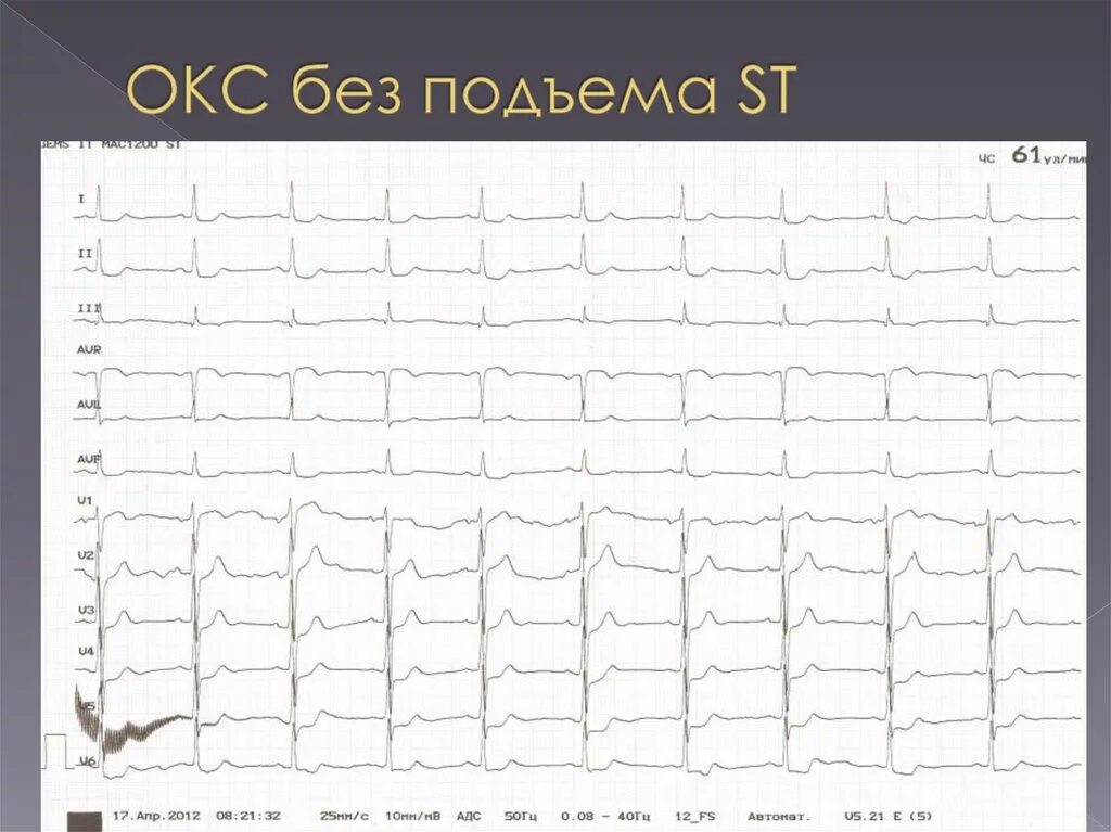 Экг подъем. Окс без подъема St кардиограмма. Окс без подъема ст на ЭКГ. ЭКГ при Окс без подъема сегмента St. ЭКГ коронарный синдром без подъема.