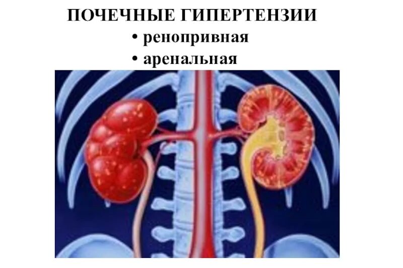 Почечная гипертония. Ренопринная почечная гипертензия. ренопривная артериальная гипертензия. почечная гипертензия патофизиология. ренопривная гипертензия патогенез.
