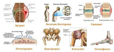 Инфекция поражающая суставы