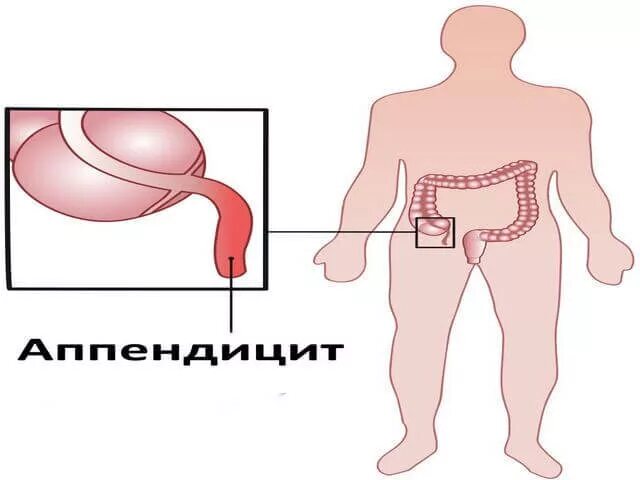 Катаральный острый аппендицит: Катаральный аппендицит. Что такое Катаральный апп