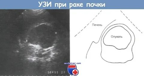 Уплотнение почки на узи