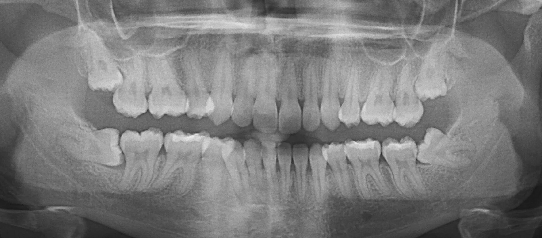 Зуб 8 нижний. Ретинированный зуб мудрости рентген. Дистопированный зуб мудрости. Ретинированный дистопированный зуб. Ретинированный дистопированный зуб мудрости.