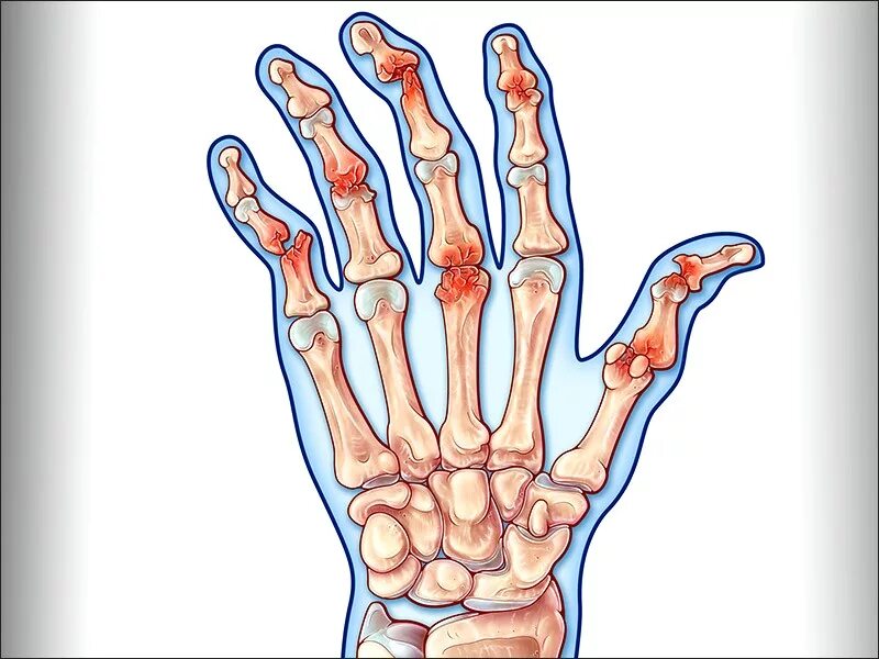 Ревматоидный артрит суставов кистей. Псориатический артрит кистей. Псориаз и псориатический артрит. Псориазный ревматоидный артрит. Псориатический артрит пальцев рук.