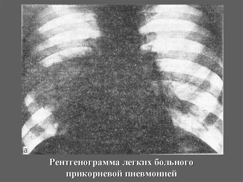 Симптомы прикорневой пневмонии у взрослых