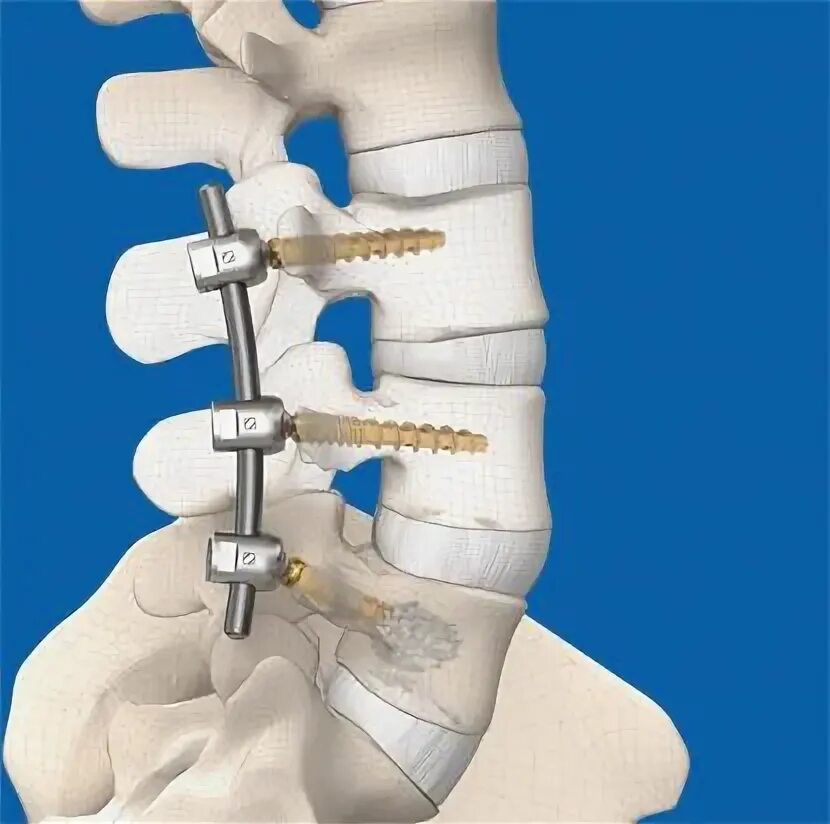 Spinal Fusion (2010) Spinal fusion, Sciatic nerve surgery, Spinal fusion surgery